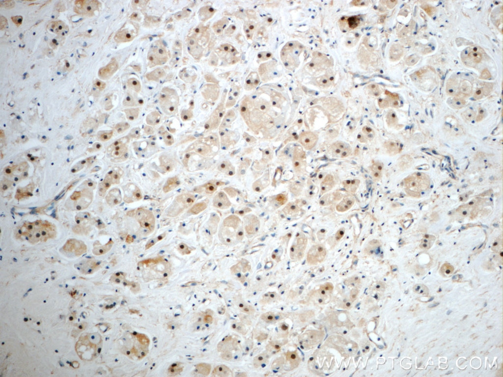 Immunohistochemistry (IHC) staining of human breast cancer tissue using SUZ12 Polyclonal antibody (20366-1-AP)