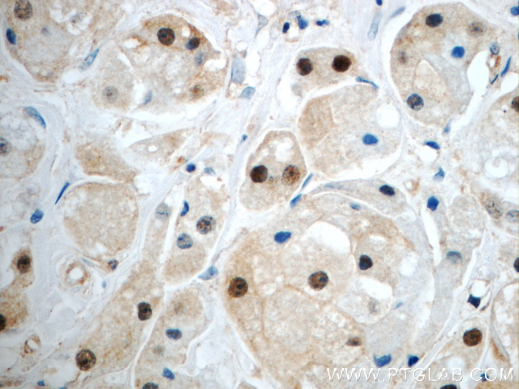Immunohistochemistry (IHC) staining of human breast cancer tissue using SUZ12 Polyclonal antibody (20366-1-AP)