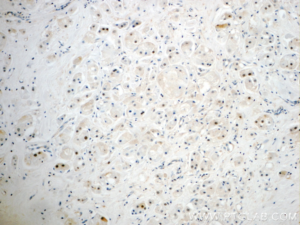 Immunohistochemistry (IHC) staining of human breast cancer tissue using SUZ12 Polyclonal antibody (20366-1-AP)