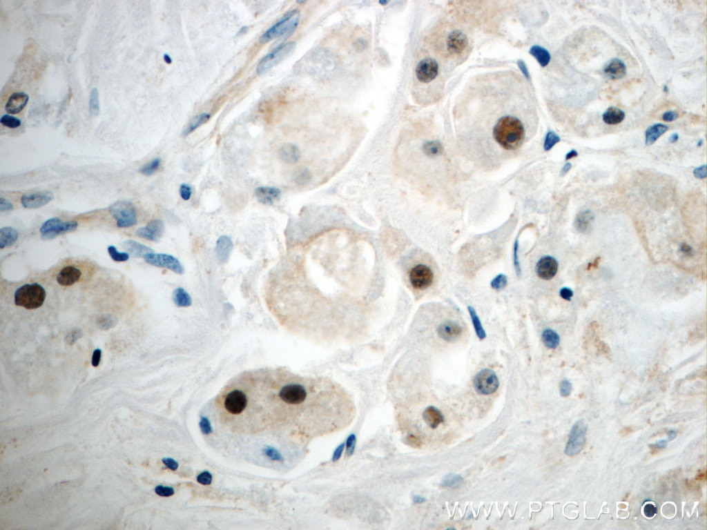 Immunohistochemistry (IHC) staining of human breast cancer tissue using SUZ12 Polyclonal antibody (20366-1-AP)