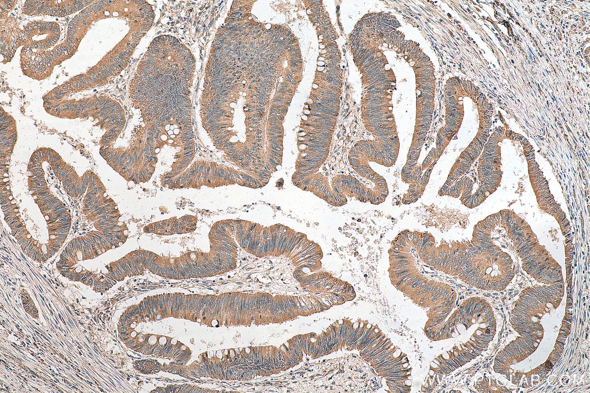 Immunohistochemistry (IHC) staining of human colon cancer tissue using SVCT2 Polyclonal antibody (27019-1-AP)