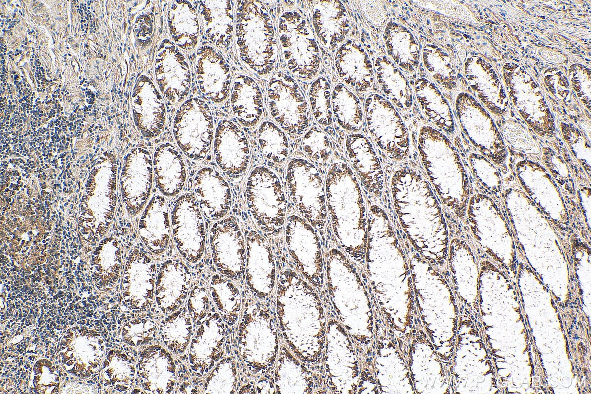 IHC staining of human colon cancer using 27019-1-AP