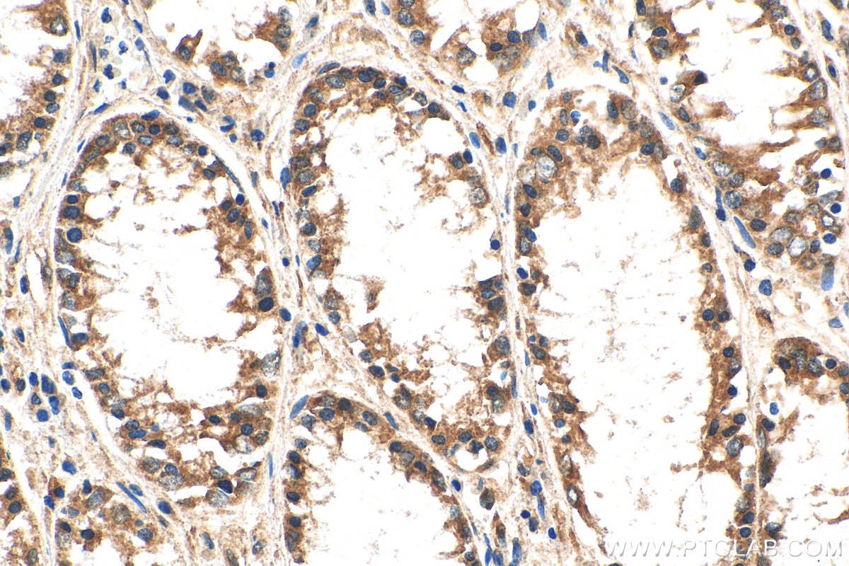 Immunohistochemistry (IHC) staining of human colon cancer tissue using SVCT2 Polyclonal antibody (27019-1-AP)