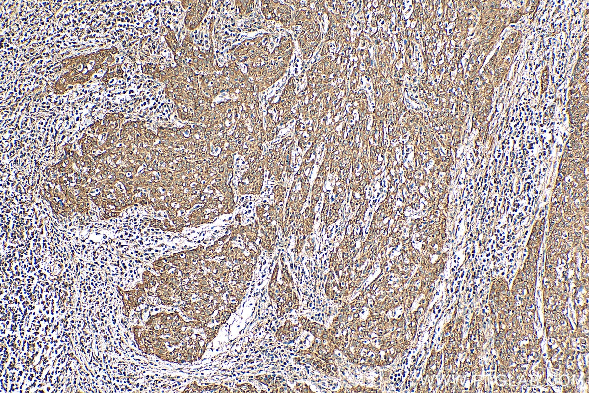 Immunohistochemistry (IHC) staining of human cervical cancer tissue using SYAP1 Polyclonal antibody (16272-1-AP)