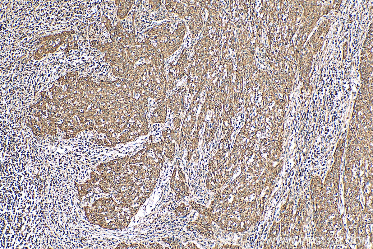 IHC staining of human cervical cancer using 16272-1-AP