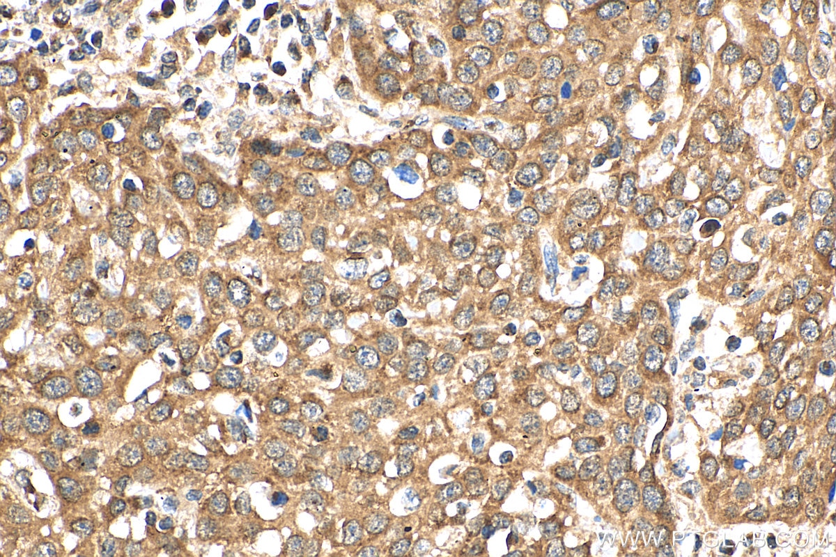 IHC staining of human cervical cancer using 16272-1-AP