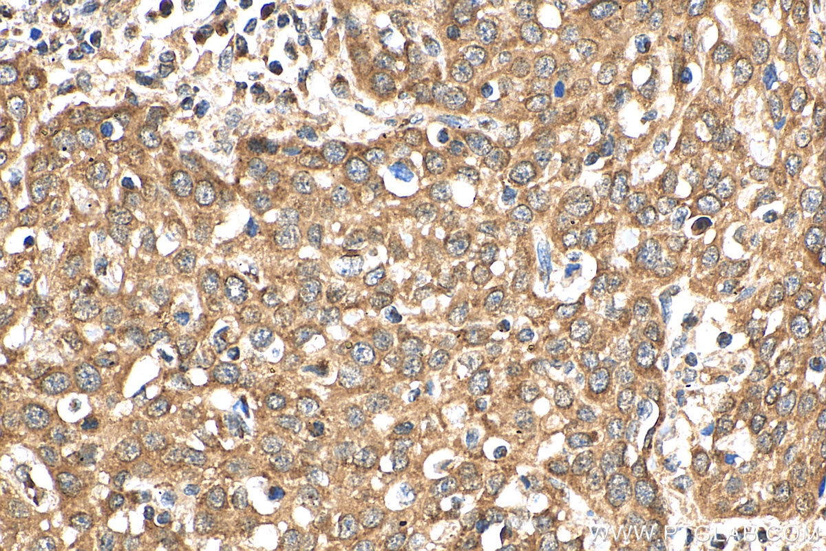 Immunohistochemistry (IHC) staining of human cervical cancer tissue using SYAP1 Polyclonal antibody (16272-1-AP)