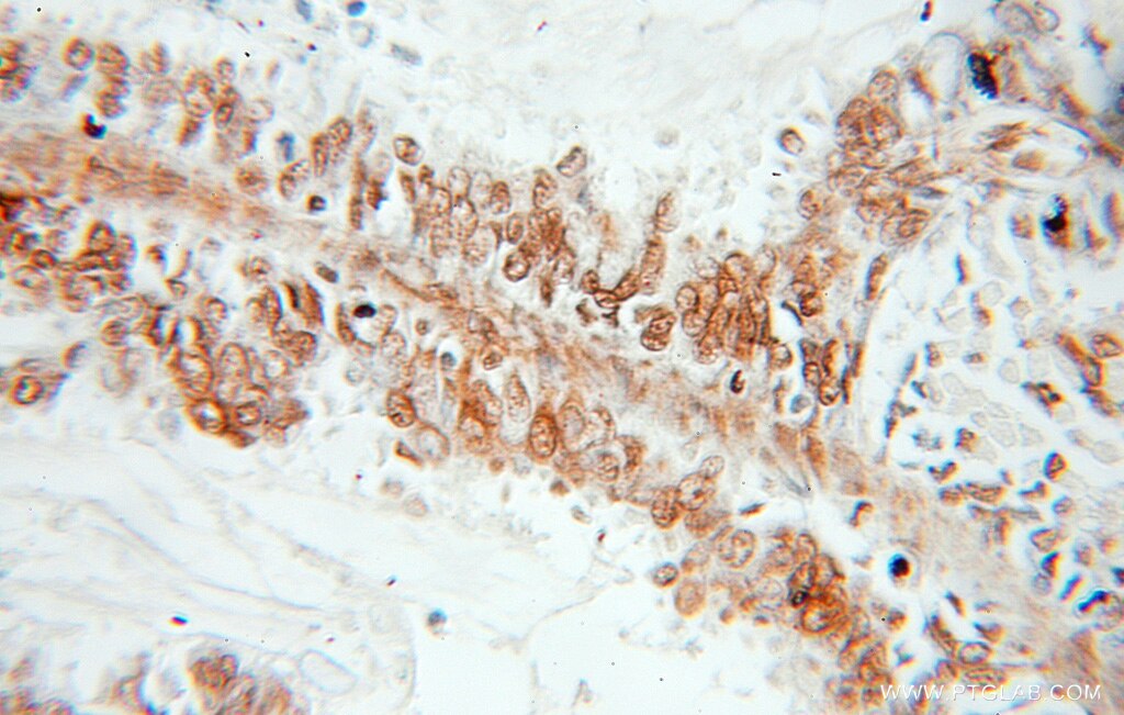 IHC staining of human ovary tumor using 11063-1-AP