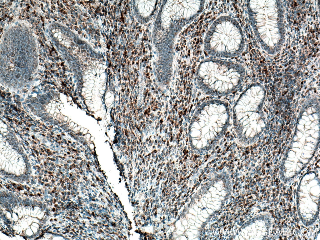 Immunohistochemistry (IHC) staining of human appendicitis tissue using SYK Polyclonal antibody (14858-1-AP)