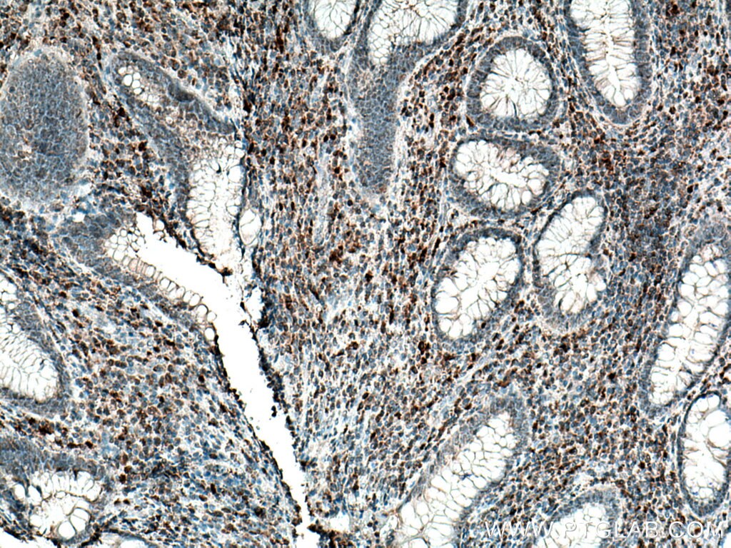 IHC staining of human appendicitis using 14858-1-AP