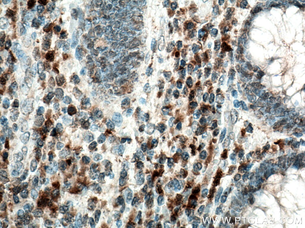 Immunohistochemistry (IHC) staining of human appendicitis tissue using SYK Polyclonal antibody (14858-1-AP)