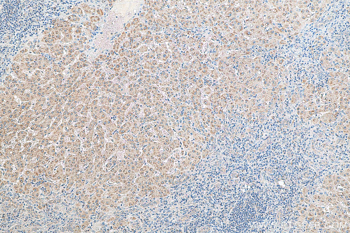 Immunohistochemistry (IHC) staining of human liver cancer tissue using SYK Polyclonal antibody (14858-1-AP)