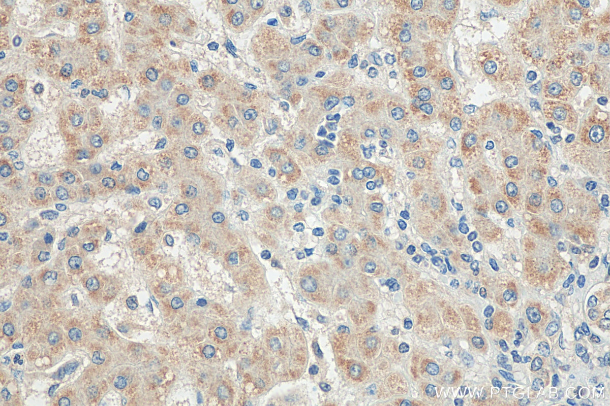 Immunohistochemistry (IHC) staining of human liver cancer tissue using SYK Polyclonal antibody (14858-1-AP)