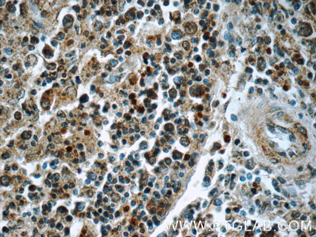 Immunohistochemistry (IHC) staining of human spleen tissue using SYK Polyclonal antibody (22206-1-AP)
