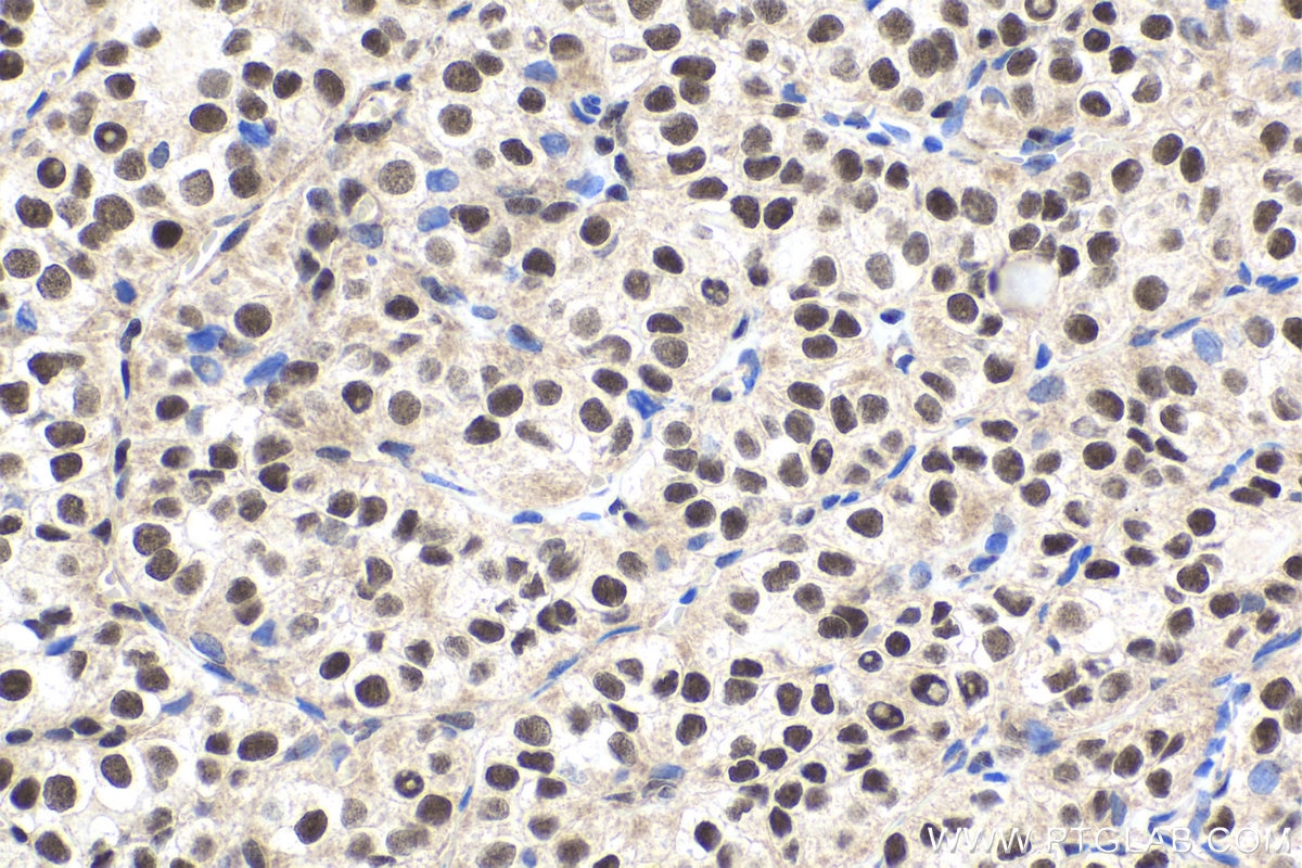IHC staining of human thyroid cancer using 11519-1-AP Immunohistochemistry (IHC) staining of human thyroid cancer tissue using Symplekin Polyclonal antibody (11519-1-AP)