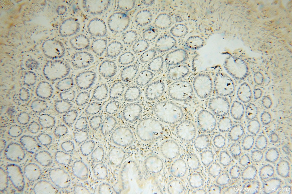 Immunohistochemistry (IHC) staining of human colon cancer tissue using Symplekin Polyclonal antibody (11519-1-AP)