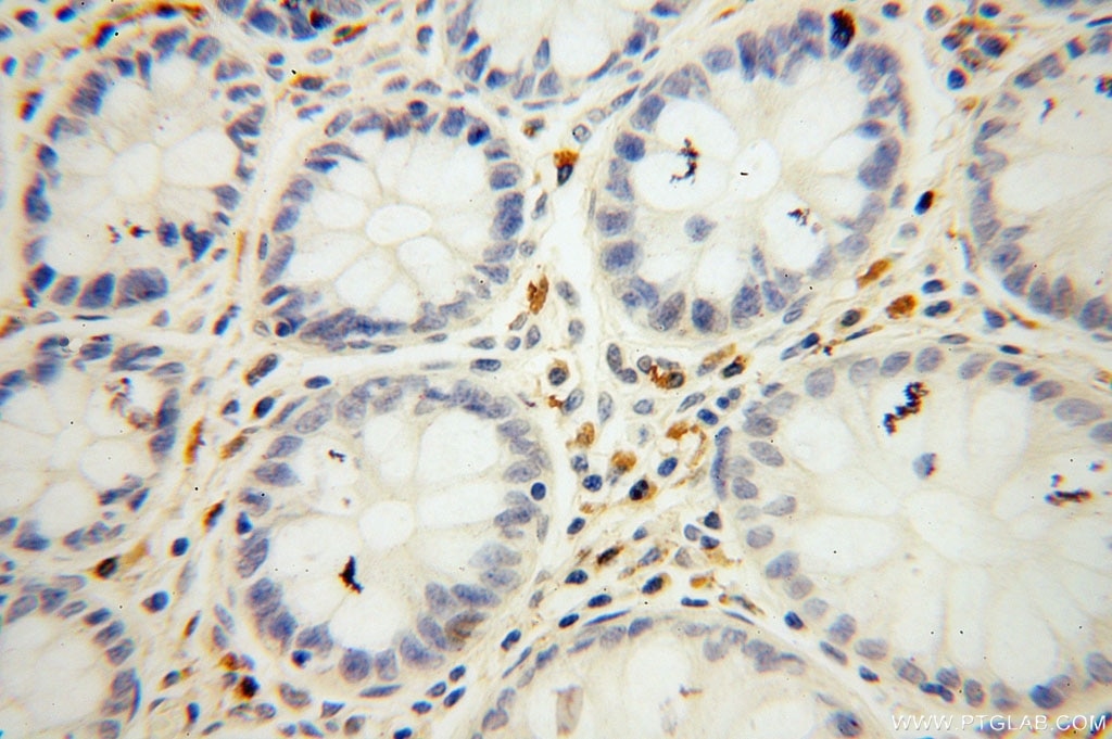Immunohistochemistry (IHC) staining of human colon cancer tissue using Symplekin Polyclonal antibody (11519-1-AP)