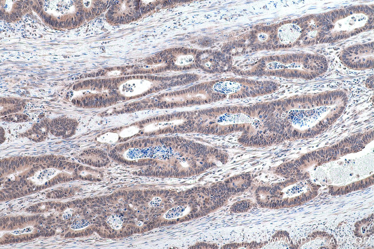 Immunohistochemistry (IHC) staining of human colon cancer tissue using SYNCRIP Polyclonal antibody (14024-1-AP)