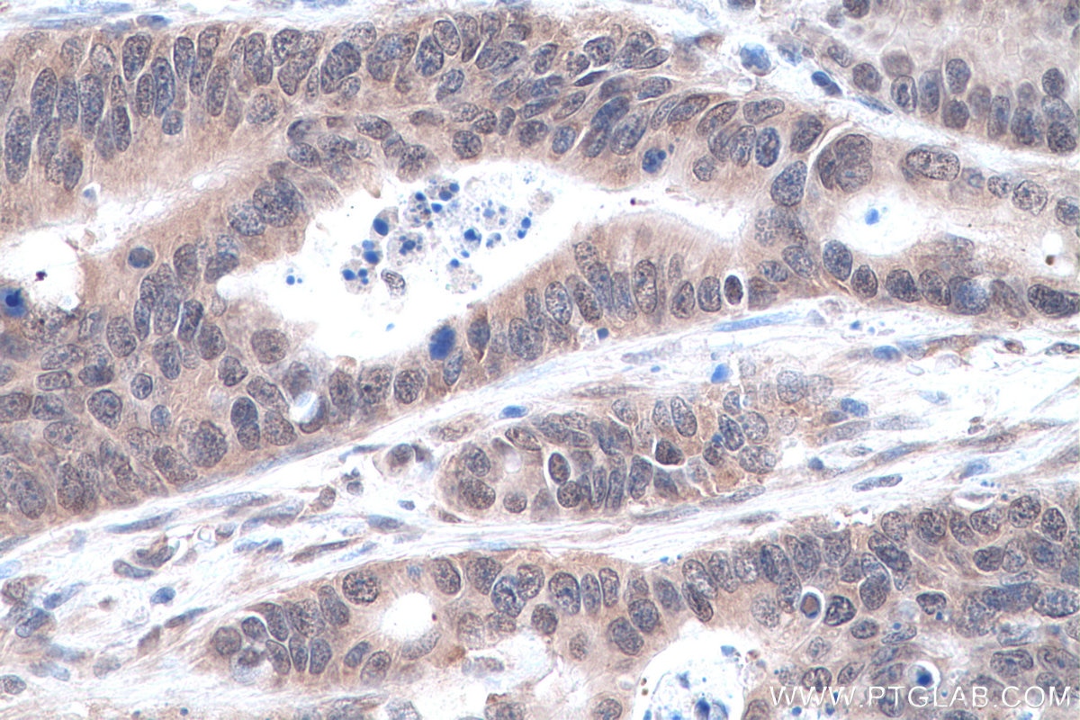 Immunohistochemistry (IHC) staining of human colon cancer tissue using SYNCRIP Polyclonal antibody (14024-1-AP)