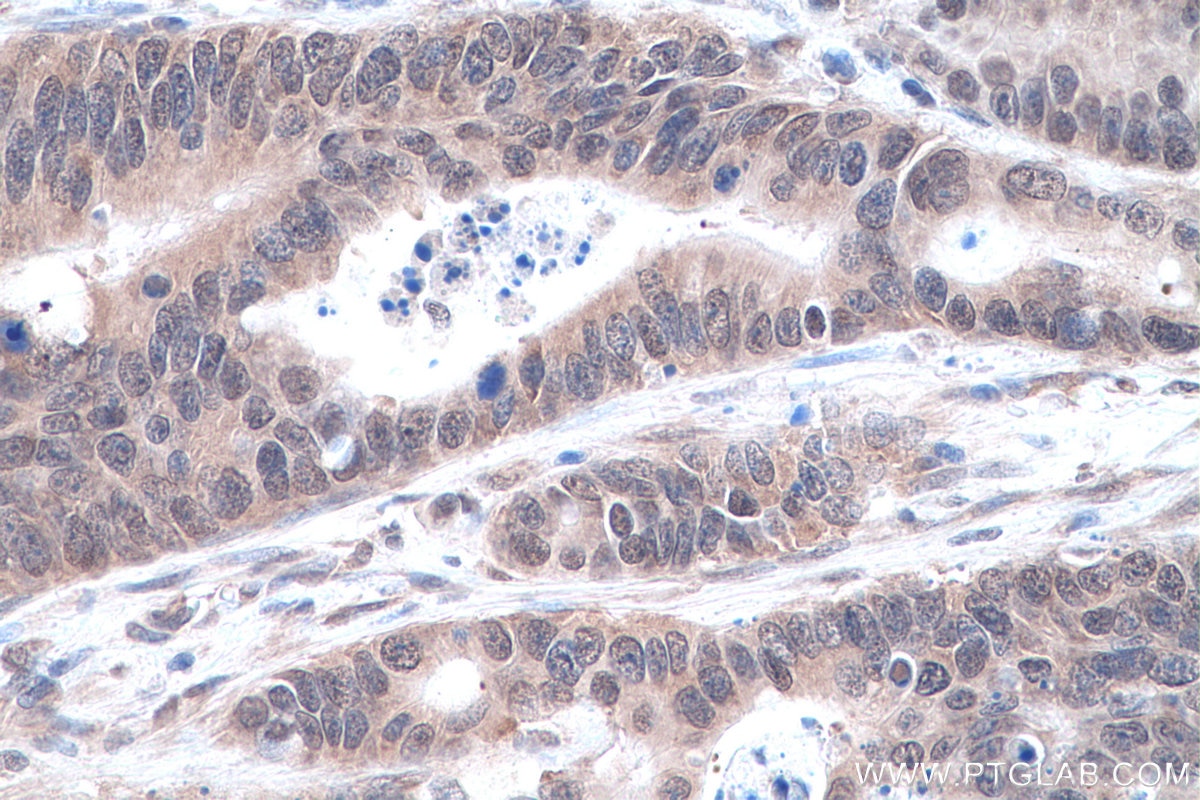Immunohistochemistry (IHC) staining of human colon cancer tissue using SYNCRIP Polyclonal antibody (14024-1-AP)