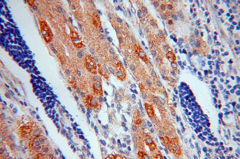 Immunohistochemistry (IHC) staining of human stomach cancer tissue using SYNJ2BP Polyclonal antibody (15666-1-AP)