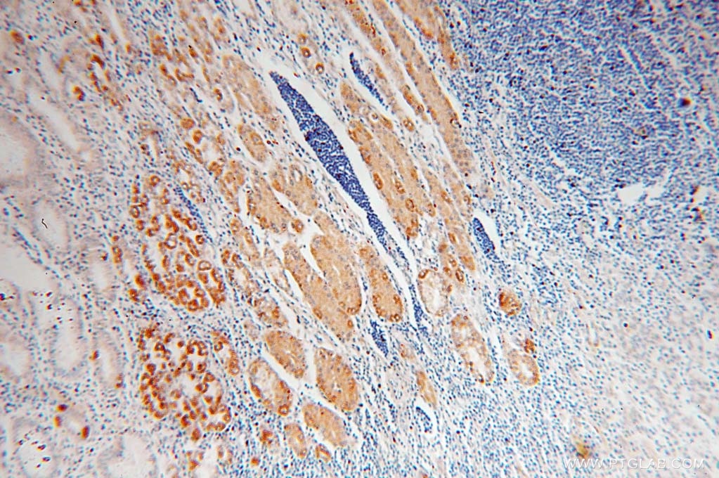 Immunohistochemistry (IHC) staining of human stomach cancer tissue using SYNJ2BP Polyclonal antibody (15666-1-AP)