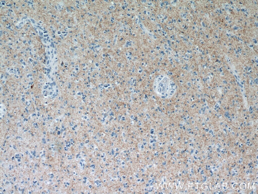 Immunohistochemistry (IHC) staining of human gliomas tissue using Synaptoporin Polyclonal antibody (14143-1-AP)