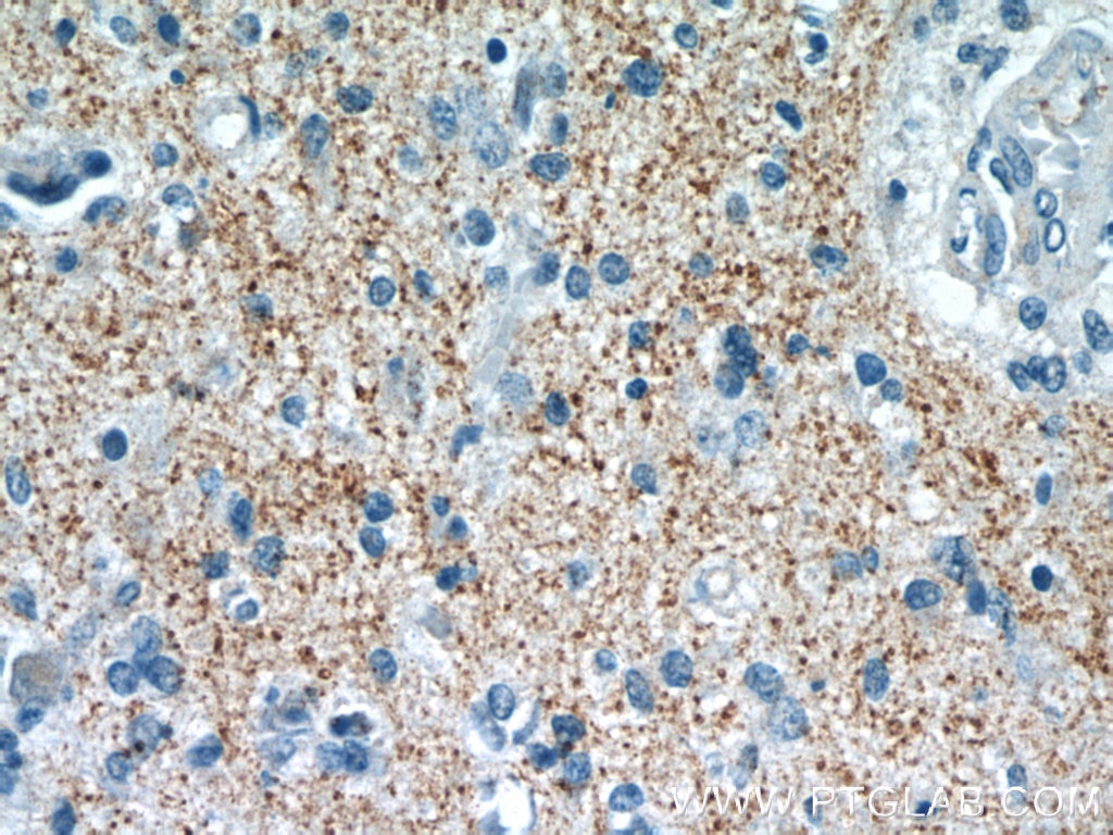 Immunohistochemistry (IHC) staining of human gliomas tissue using Synaptoporin Polyclonal antibody (14143-1-AP)