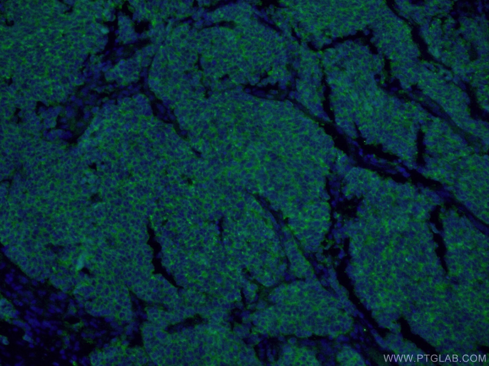 Immunofluorescence (IF) / fluorescent staining of human lung cancer tissue using Synaptophysin Polyclonal antibody (17785-1-AP)