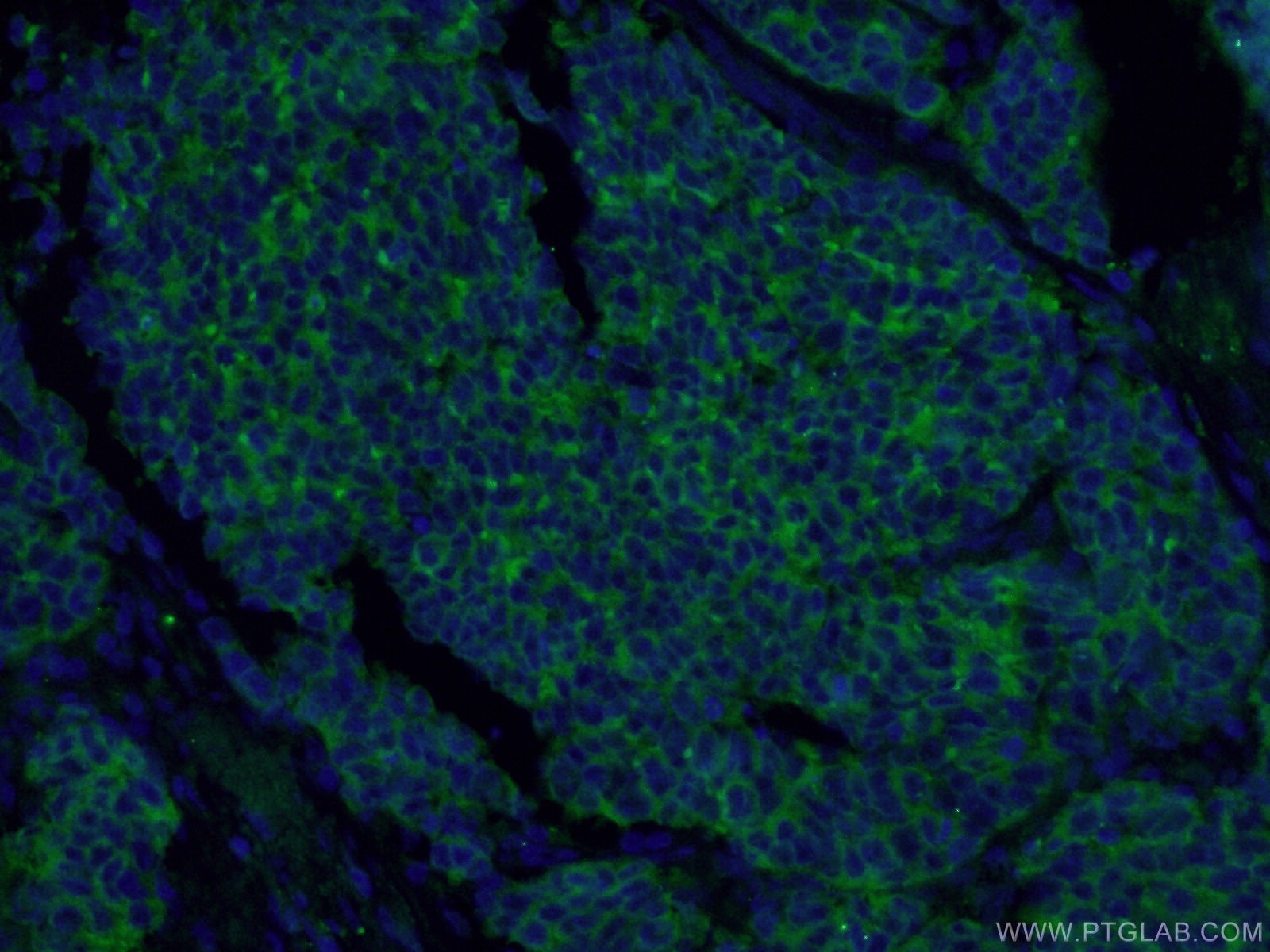 Immunofluorescence (IF) / fluorescent staining of human lung cancer tissue using Synaptophysin Polyclonal antibody (17785-1-AP)