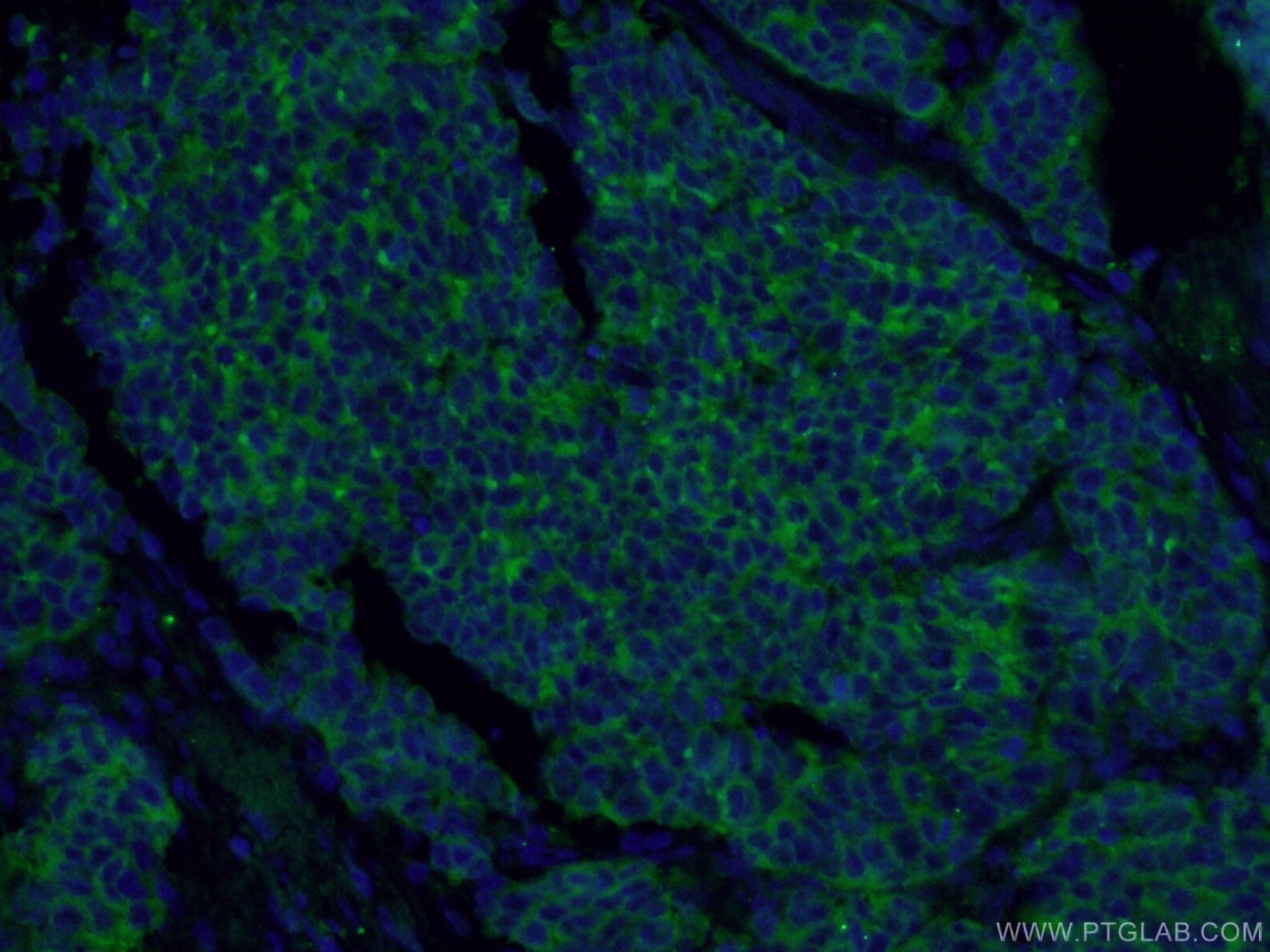 IF Staining of human lung cancer using 17785-1-AP