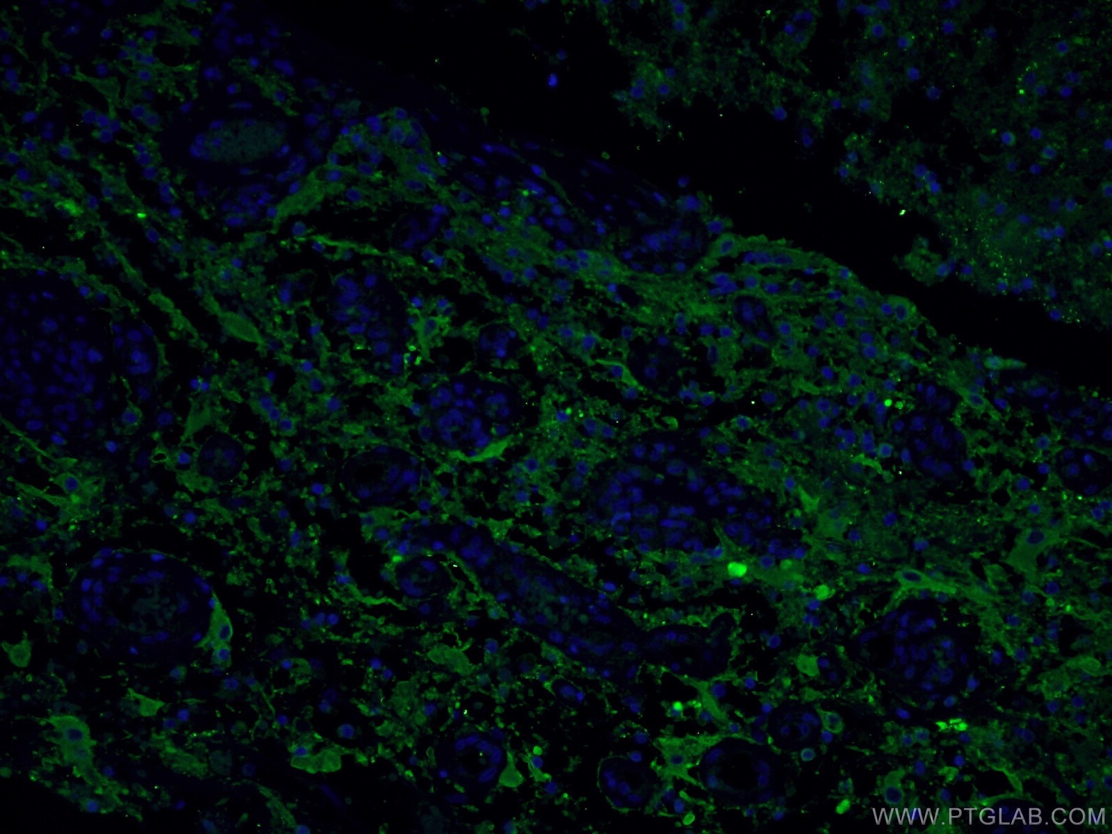 Immunofluorescence (IF) / fluorescent staining of human gliomas tissue using Synaptophysin Polyclonal antibody (17785-1-AP)