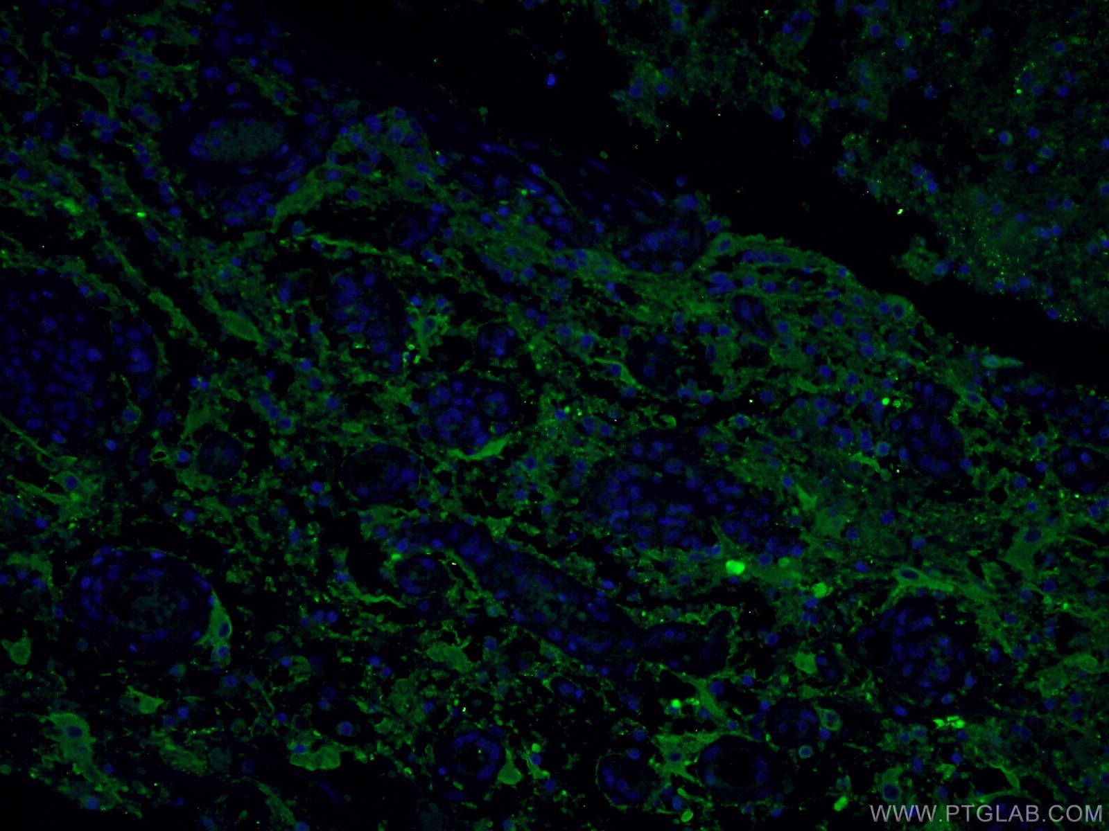 IF Staining of human gliomas using 17785-1-AP