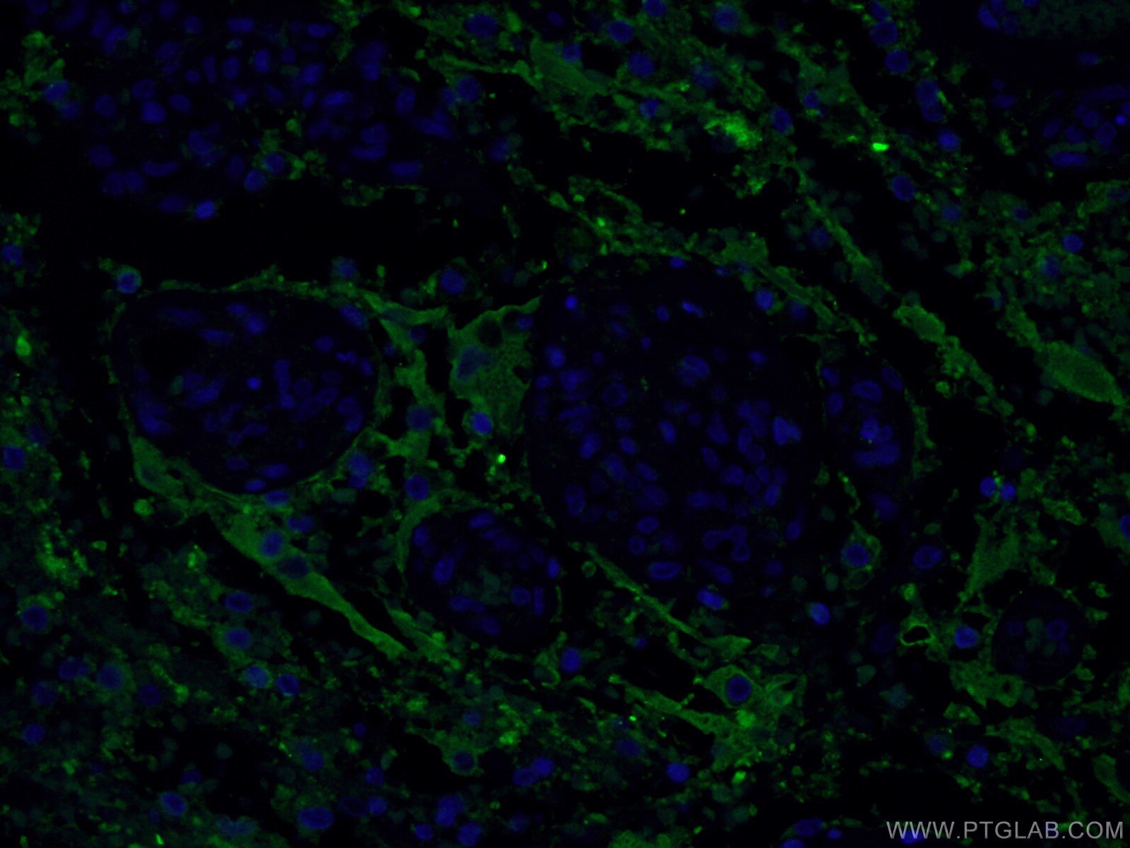 IF Staining of human gliomas using 17785-1-AP