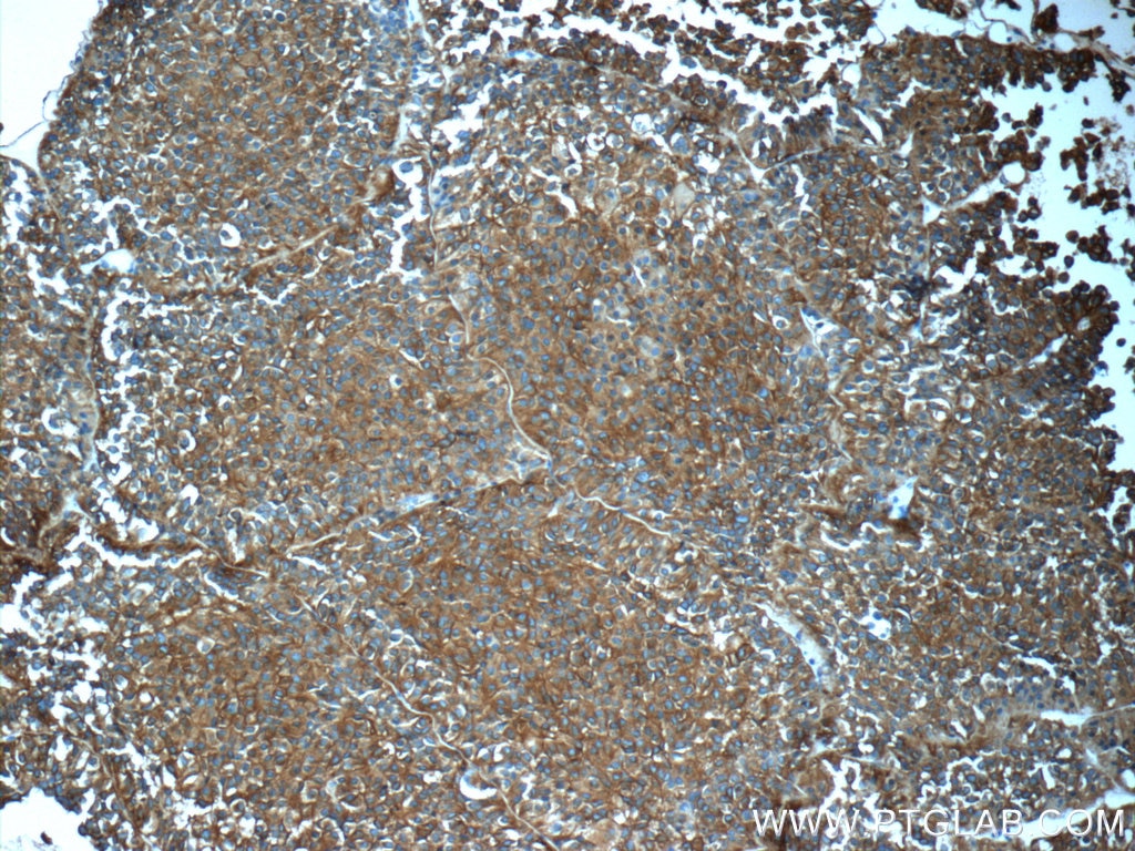 Immunohistochemistry (IHC) staining of human pituitary adenoma tissue using Synaptophysin Polyclonal antibody (17785-1-AP)