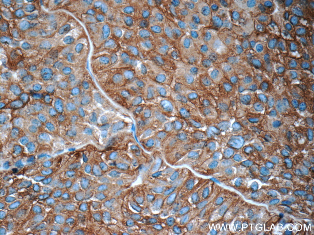 Immunohistochemistry (IHC) staining of human pituitary adenoma tissue using Synaptophysin Polyclonal antibody (17785-1-AP)