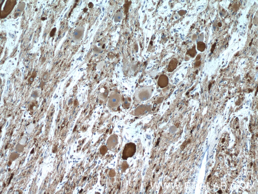 Immunohistochemistry (IHC) staining of ganglioma tissue using Synaptophysin Polyclonal antibody (17785-1-AP)