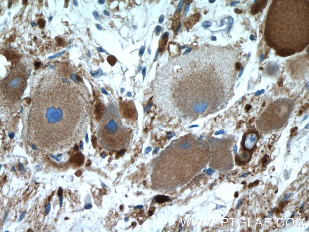 Immunohistochemistry (IHC) staining of ganglioma tissue using Synaptophysin Polyclonal antibody (17785-1-AP)