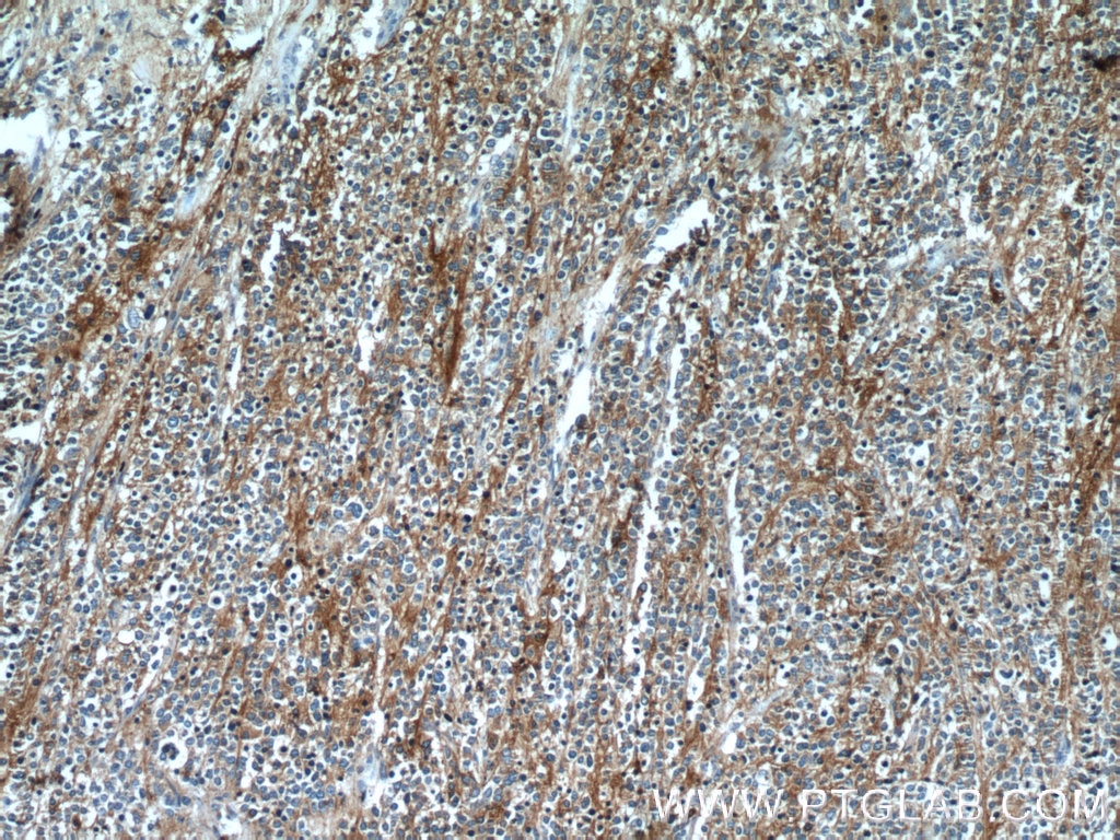 Immunohistochemistry (IHC) staining of neuroblastoma tissue using Synaptophysin Polyclonal antibody (17785-1-AP)