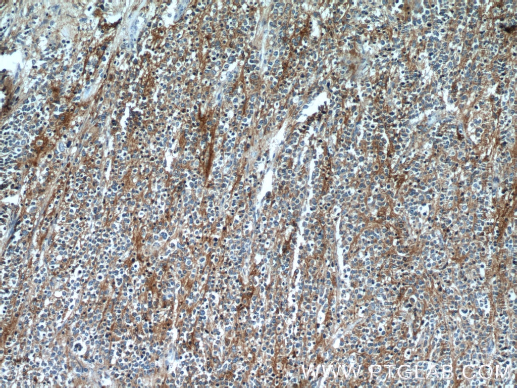 IHC staining of neuroblastoma using 17785-1-AP