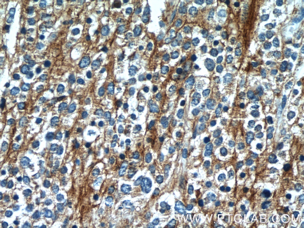 Immunohistochemistry (IHC) staining of neuroblastoma tissue using Synaptophysin Polyclonal antibody (17785-1-AP)