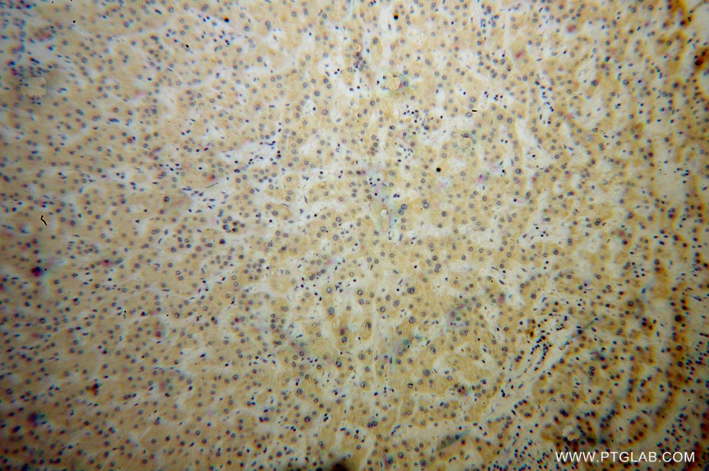 Immunohistochemistry (IHC) staining of human liver cancer tissue using Synaptotagmin-1 Polyclonal antibody (14511-1-AP)