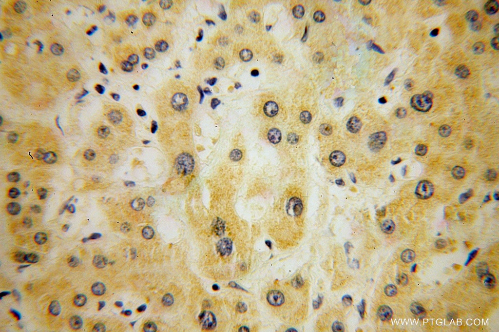 Immunohistochemistry (IHC) staining of human liver cancer tissue using Synaptotagmin-1 Polyclonal antibody (14511-1-AP)