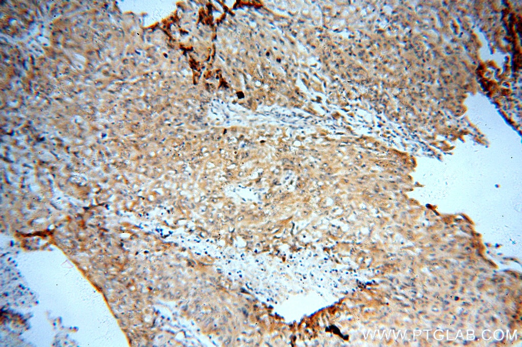 Immunohistochemistry (IHC) staining of human lung cancer tissue using SYT17 Polyclonal antibody (15413-1-AP)