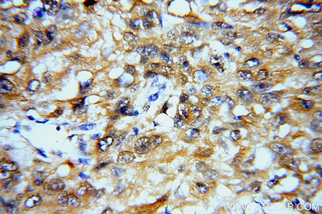 Immunohistochemistry (IHC) staining of human lung cancer tissue using SYT17 Polyclonal antibody (15413-1-AP)