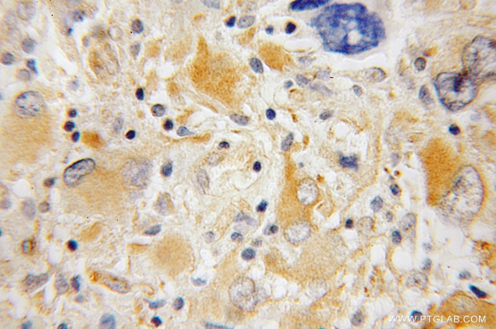 Immunohistochemistry (IHC) staining of human gliomas tissue using Synaptotagmin-4 Polyclonal antibody (12642-1-AP)