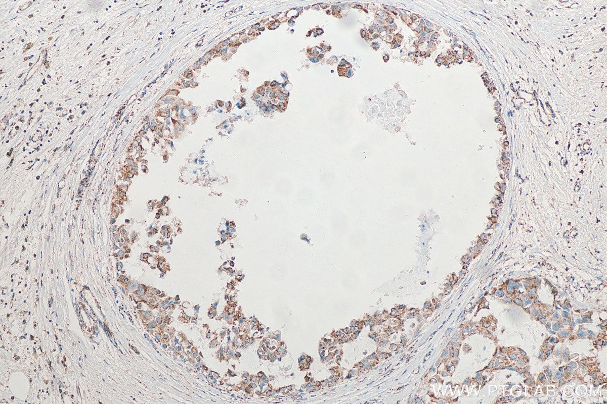 Immunohistochemistry (IHC) staining of human breast cancer tissue using SYTL2 Polyclonal antibody (12359-1-AP)