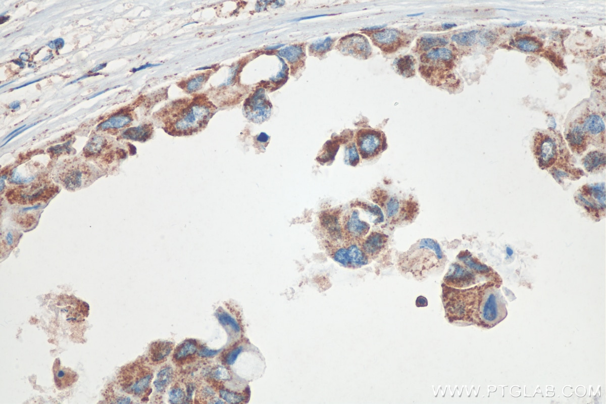 Immunohistochemistry (IHC) staining of human breast cancer tissue using SYTL2 Polyclonal antibody (12359-1-AP)