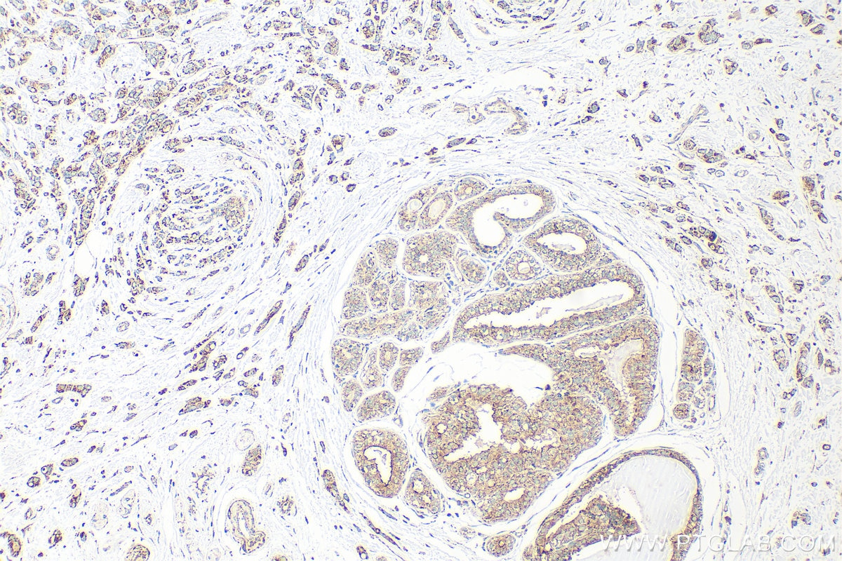 Immunohistochemistry (IHC) staining of human breast cancer tissue using SYTL2 Polyclonal antibody (12359-1-AP)