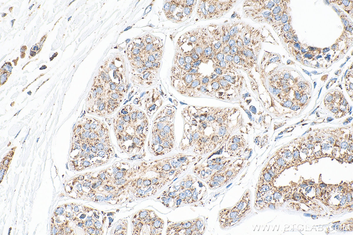 Immunohistochemistry (IHC) staining of human breast cancer tissue using SYTL2 Polyclonal antibody (12359-1-AP)